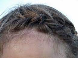 What should i do if i have a chemical burn from bleach? Bleach Burn On Scalp Treatment For Irritation Blisters Scabs