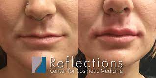juvederm lip filler for very thin lips