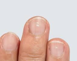what do white spots on nails mean