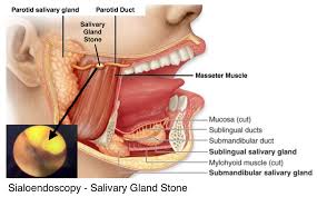 minimally invasive salivary gland