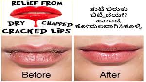 dry lips in kannada chapped lips in