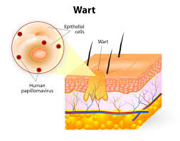 Diagram Of Hpv Wart Reading Industrial Wiring Diagrams