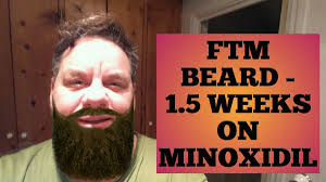 Ftm beard transplant cost ftm full beard transplants with advanced equipment to fill in facial areas that currently don't grow hair can cost starts from €2, 000 again depending on the number of. Ftm Beard Growth On Minoxidil Rogain Week 1 5 Minoxidil Beard Side Effects Is It Really Effective
