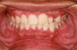 gum swelling causes treatment