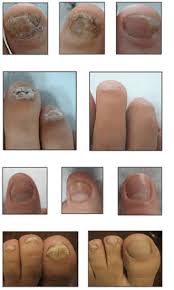 onychomycosis fungal nail laser