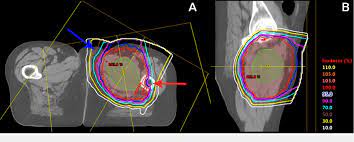 neoadjuvant pencil beam scanning proton