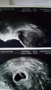 Ich war in der 7. Ultraschall 5 4 Nichts Zu Sehen Angst Forum Schwangerschaft Urbia De