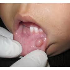 mucocele in the lower lip of baby at 11