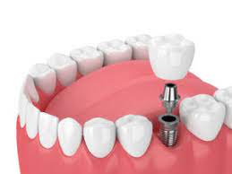 We did not find results for: 5 Ways To Get Low Cost Dental Implants Newmouth