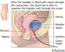 bladder cancer information mount