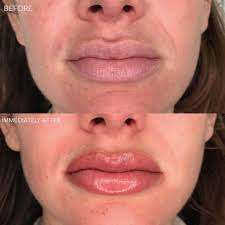 semi permanent lip contour and full