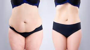 why tummy tuck is still the best choice