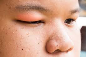 reasons behind swollen eyelids causes