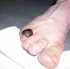 blood blister on foot do s and don ts