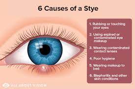 what causes a stye all about vision