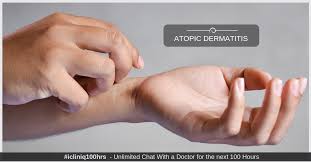 how is atopic dermais treated