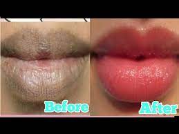 get rid of dark lips caused by smoking