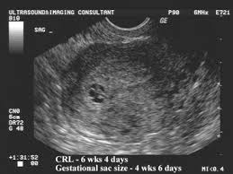 Abnormalities In The Size Of The Gestational Sac