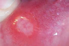 march mouth ulcers news and features
