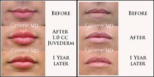 lip augmentation and enhancement expert
