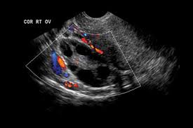 Ultrasound in preoperative assessment of pelvic and abdominal spread in patients with ovarian. Gps Refused Access To Ovarian Cancer Scans Gponline