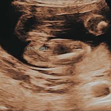Pemeriksaan ultrasonografi (usg) adalah hal yang sangat dianjurkan untuk perempuan hamil. Hasil Gambar Usg Bayi Perempuan