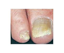 why our toenails thicken as we age