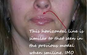 horizontal line above lip no botox