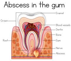 dental abscess know the symptom
