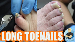 t super thick and long toenails