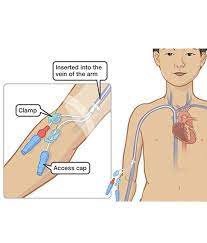 hickman line picc line insertion for