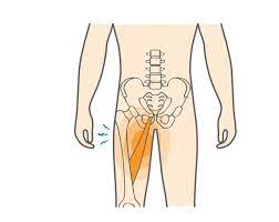 This implies an injury to the inner thigh muscles. Groin Pull Upswing Health