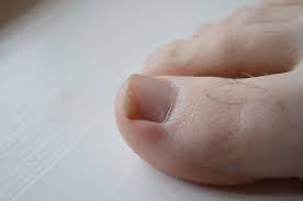 ingrown toenail toenail fungus