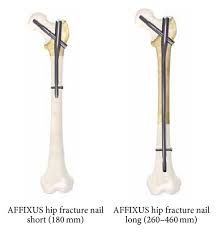 affixus hip fracture nail