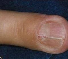 nail bed injury hand orthobullets