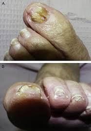 topical antifungal nail lacquer