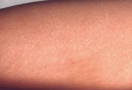 Pictures Of Childhood Skin Problems Common Rashes And More