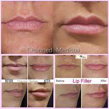 lip filler what to expect charmed