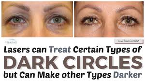 treating dark circles how lasers can