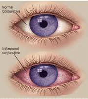 uhs health topic pink eye