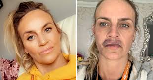 woman s lip fillers done at home
