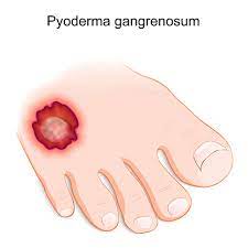 Pyoderma Gangrenosum