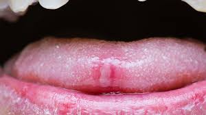 Mundfäule tritt meistens bei kleinkindern im alter zwischen 10 monaten und 3 jahren auf; Aphthe Im Mund Was Lost Sie Aus Die Besten Tipps Zur Behandlung Stern De