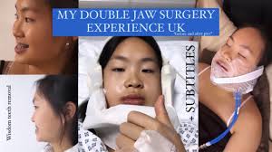 double jaw surgery wisdom teeth