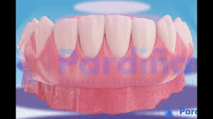 Dentures are full or partial dental prosthesis to replace your missing teeth. Cover Denture Prothese C Youtube