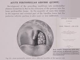 peritonsillar abscess management iowa