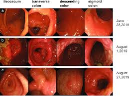 Thank you, {{form.email}}, for signing up. A Colonoscopy Of The Ascending Colon Transverse Colon Descending Download Scientific Diagram