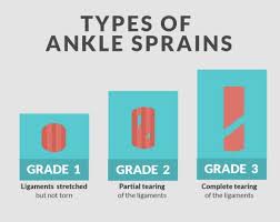 The Ultimate Guide to Ankle Sprain Treatment   South Perth    