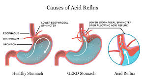acid reflux gerd symptoms causes