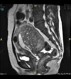 Image result for what is the icd 10 code for adenomyosis